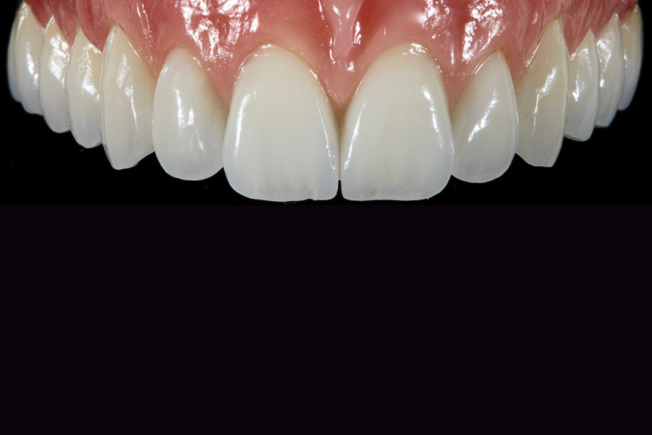 Протез на имплантате в эстетической зоне — произведение искусства