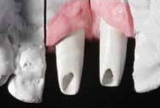 Протез на имплантате в эстетической зоне — произведение искусства