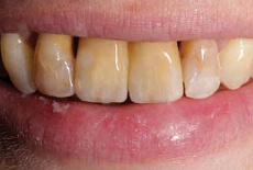 Протез на имплантате в эстетической зоне — произведение искусства