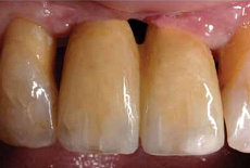 Протез на имплантате в эстетической зоне — произведение искусства