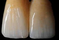 Протез на имплантате в эстетической зоне — произведение искусства