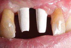 Протез на имплантате в эстетической зоне — произведение искусства